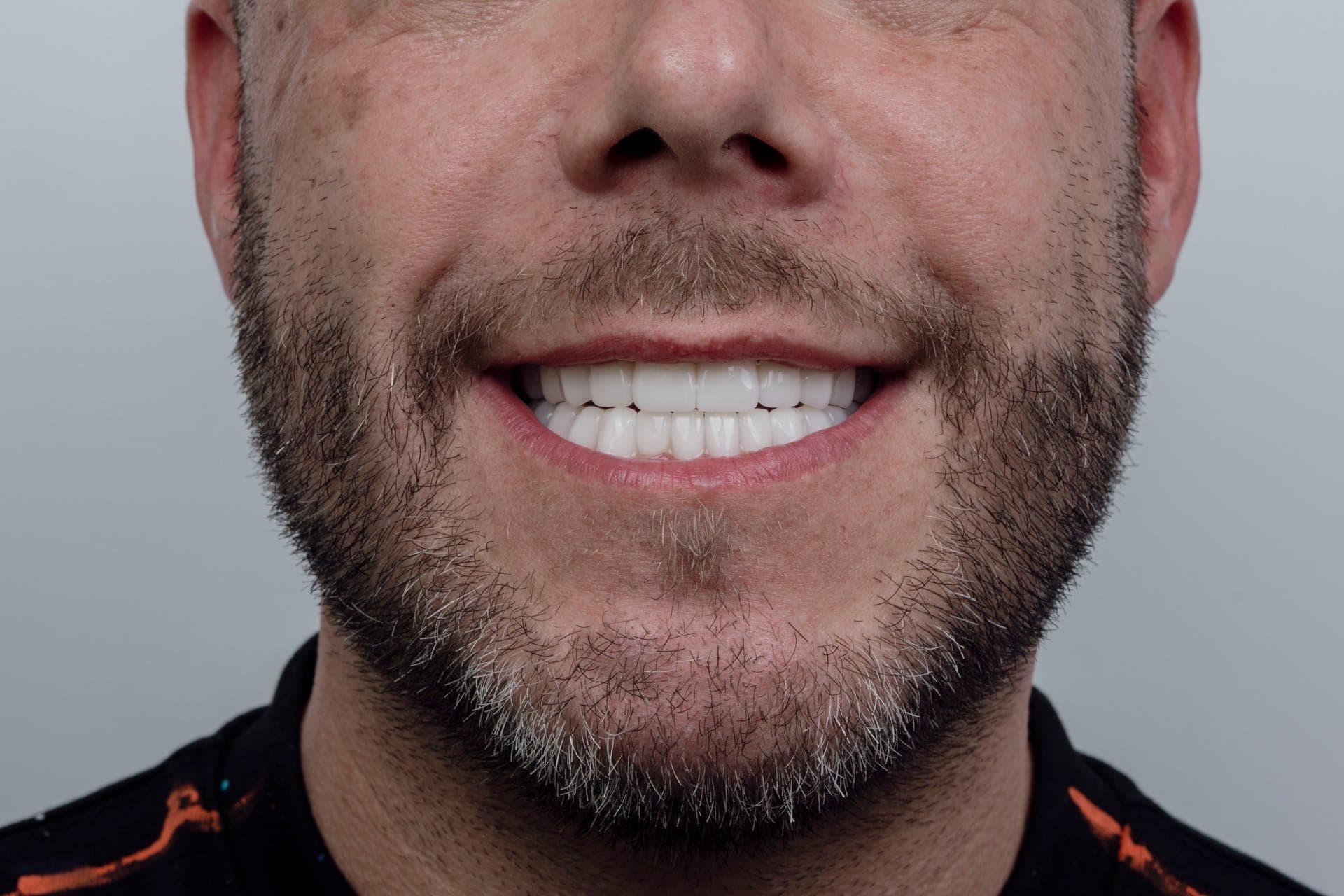 Smile Design result 18