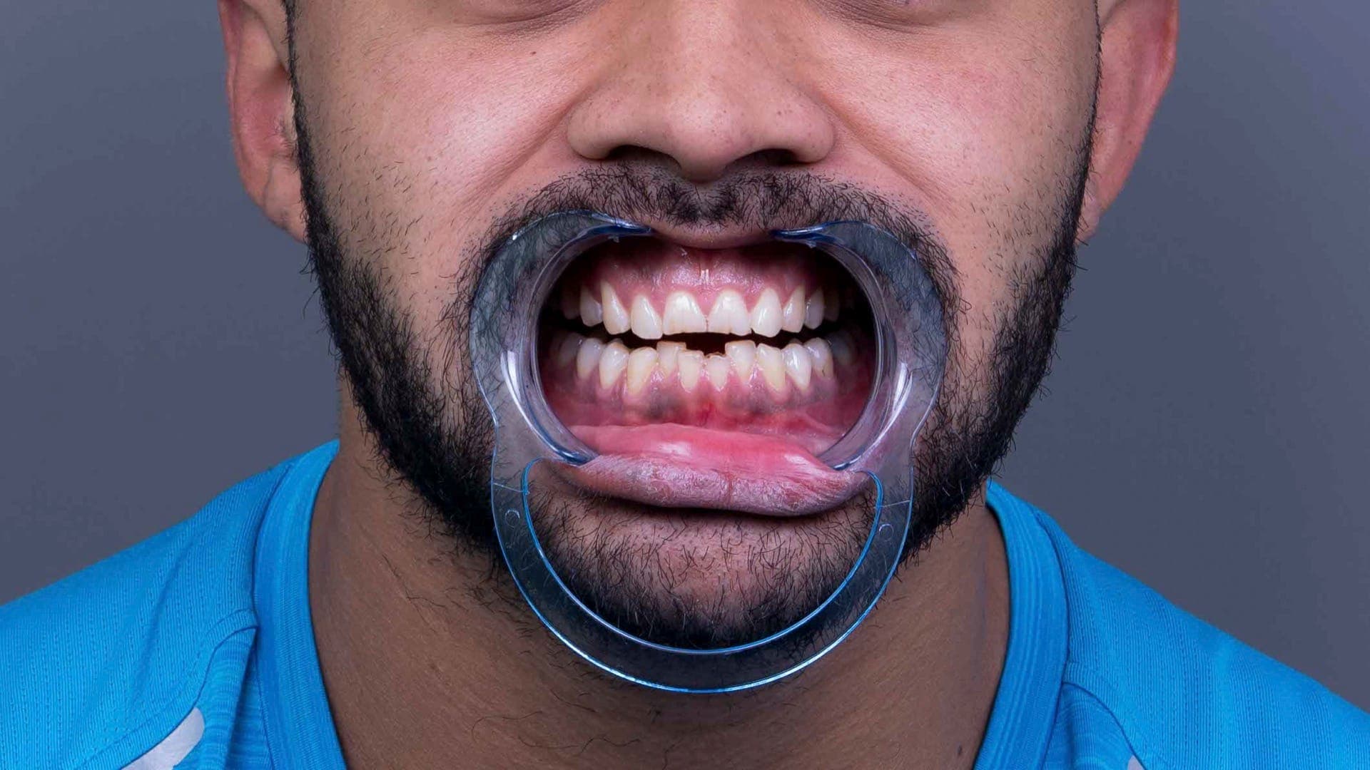 Smile Design result 15