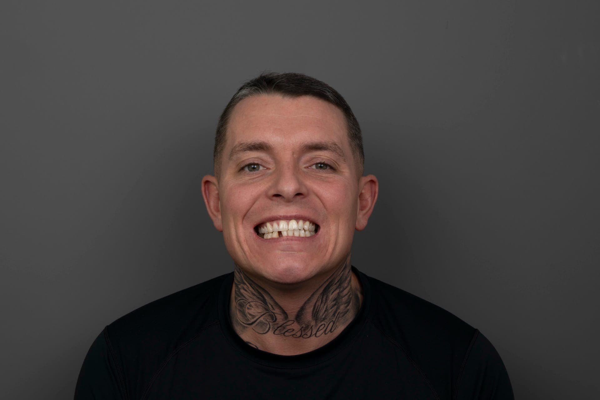Smile Design result 4