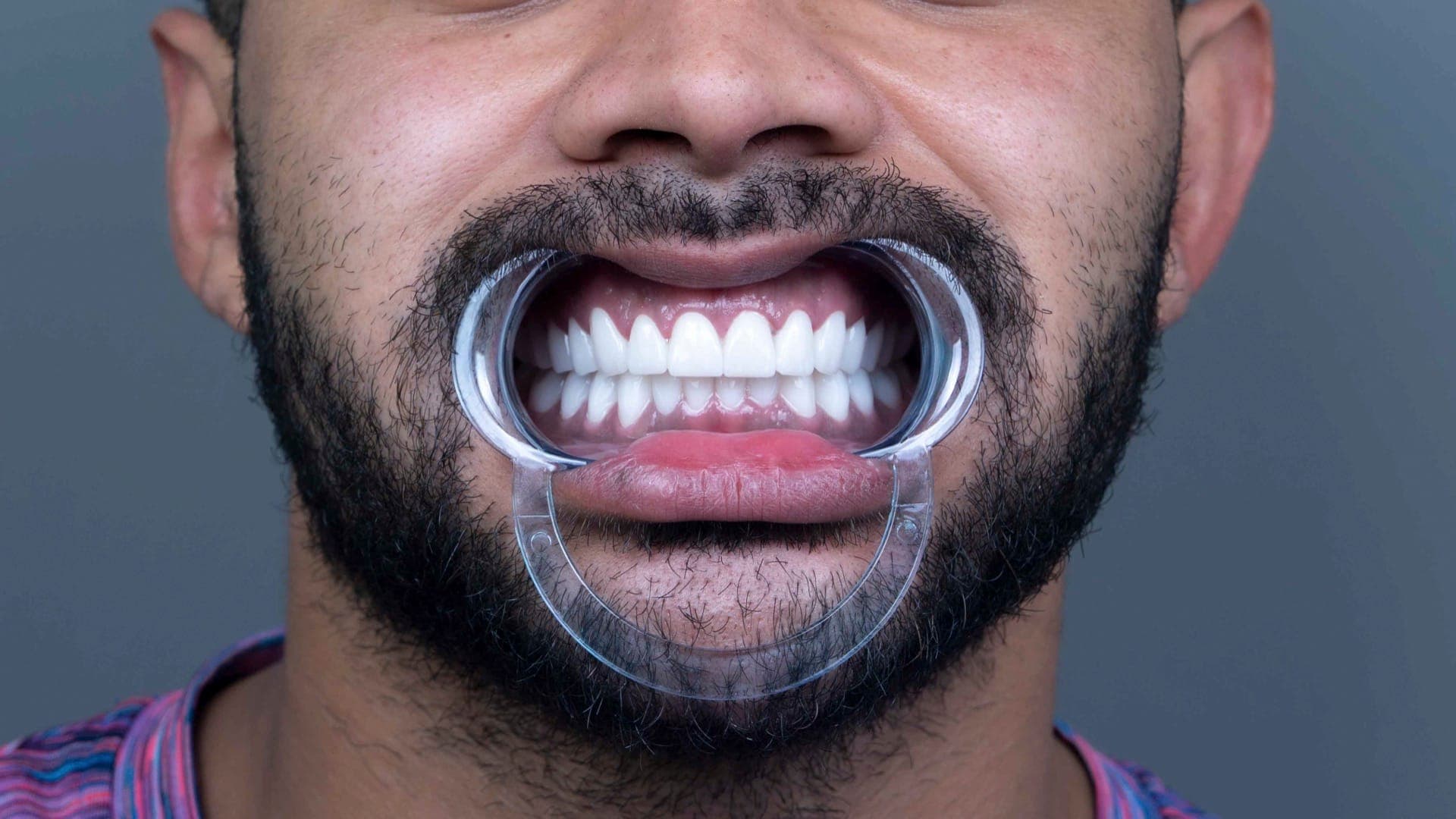 Smile Design result 14