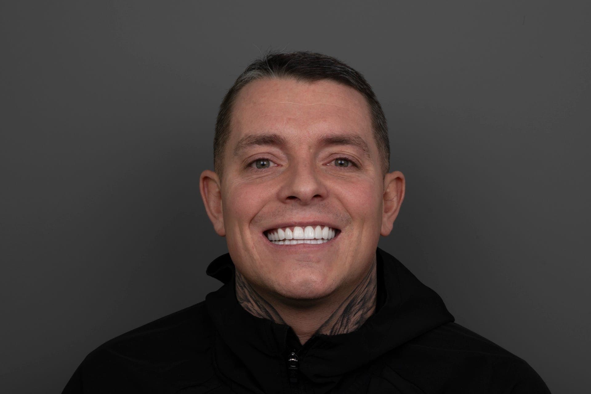 Smile Design result 3