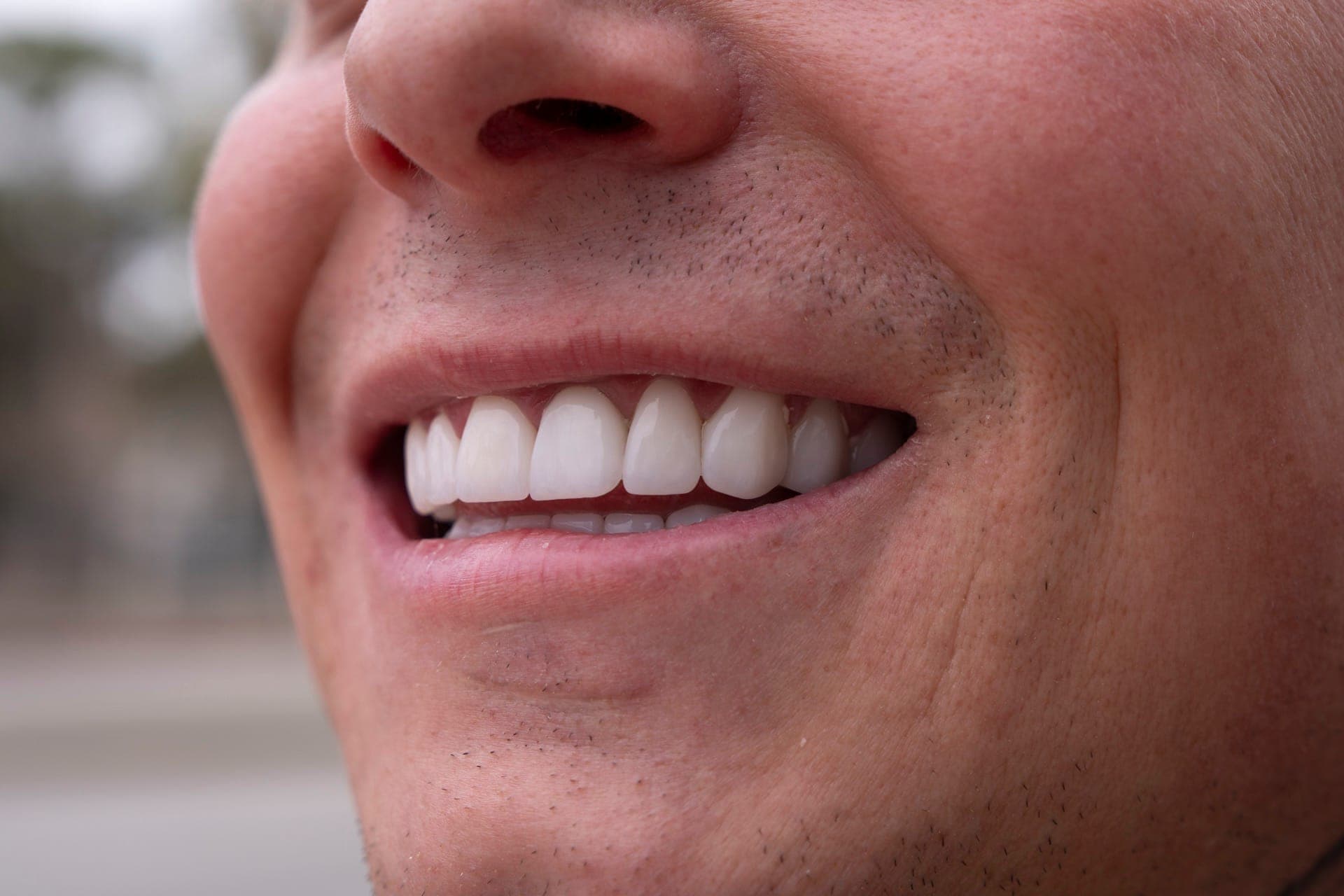 Smile Design result 2